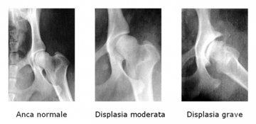 Riflessioni sulla Displasia dell’anca
